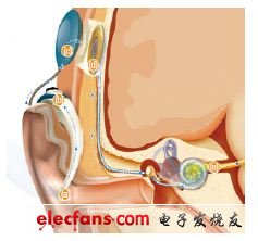 圖5,植入耳蝸將聲音轉換為電脈沖,送給聽覺神經。話筒將聲音捕捉給聲音處理器(a)。聲音處理器將聲音轉換為詳細的數學信息 (b)。
